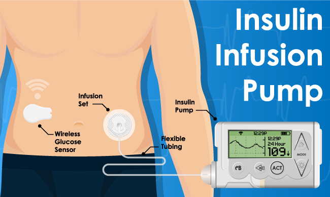 Portal Battery Powered Insulin Infusion Pump Using IoT Technology